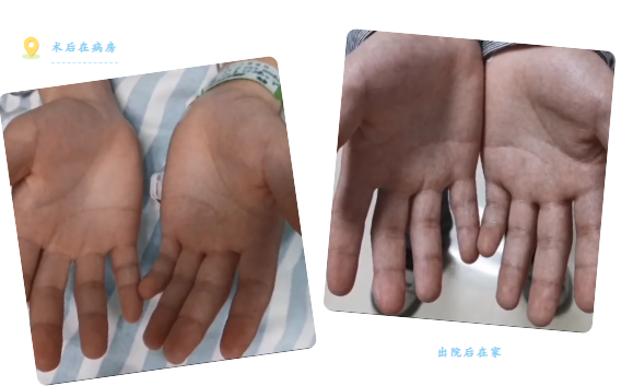 【精术】大学生害怕牵手，竟是10年“水手”作祟——终于，在河池市三医院治愈